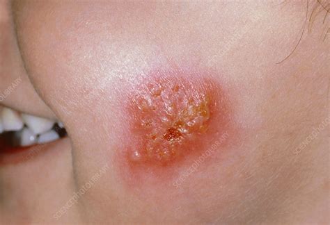 Impetigo Lesion On A Childs Cheek Stock Image M1800051 Science