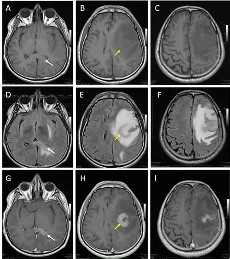 Primary Cns Lymphoma With Recurrence Radiology Cases