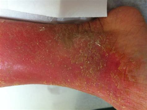 Bad Eczema Dorothee Padraig South West Skin Health Care