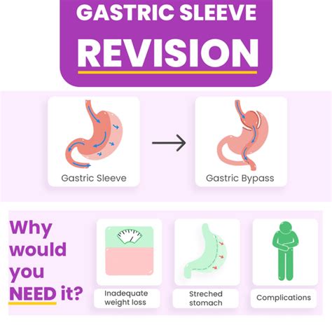 Gastric Sleeve Revision Surgery Resetting Your Goals