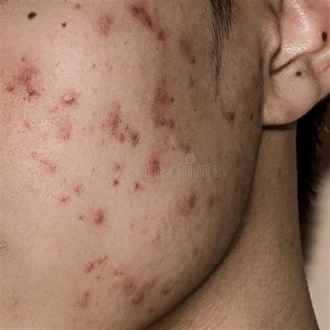 Close Up Of Acne On The Skin Acne On The Face Caused By Hormone Stock