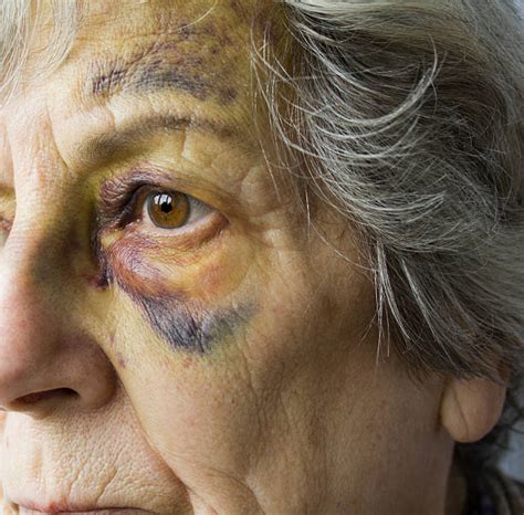 100 Senior Women Bruise Beaten Up Human Face Stock Photos Pictures