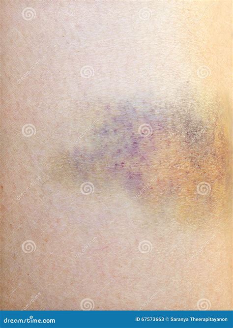 Purple Bruise Stock Image Image Of Violence Purple 67573663