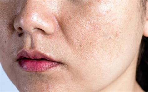 Open Pores On Face Dr Walias Skin And Laser Clinic