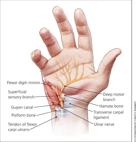 Ulnar Wrist Pain Causes