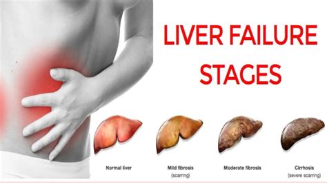 ⚓⚓liver Failure Stages