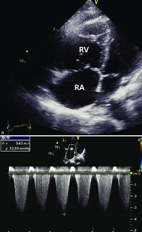 A Echocardiography Showed Right Ventricular Dilatation B And