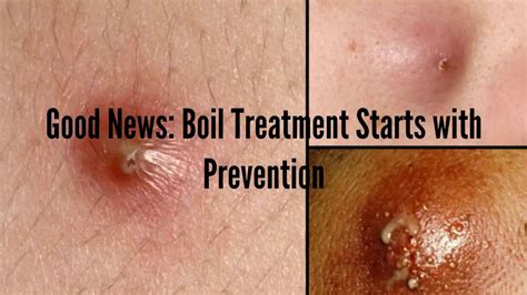 The Big 3 Ways To Prevent Boils Boil Treatment Begins With Prevention