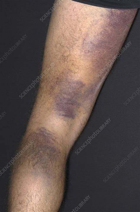 Bruised Leg Stock Image M3301701 Science Photo Library