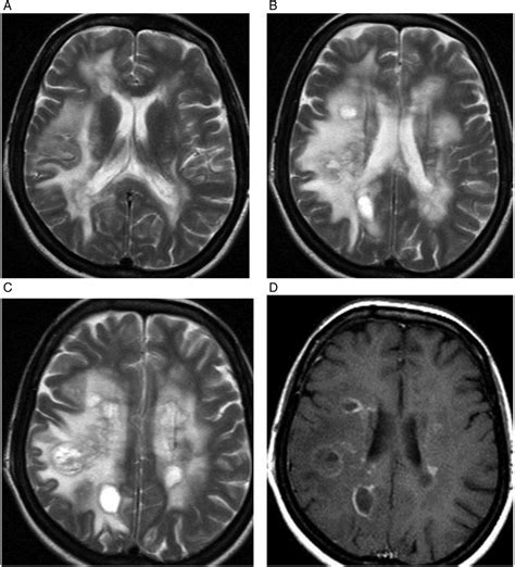 Imaging In Multiple Sclerosis And Related Disorders Practical Neurology