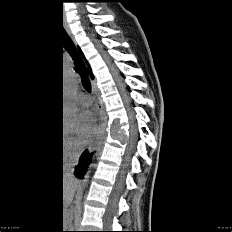 Multiple myeloma is a common malignancy in patients above 40 (70% of cases are diagnosed mri is more sensitive in detecting multiple lesions compared to the standard plain film skeletal survey and. Plasmacytoma / multiple myeloma - spine | Image ...