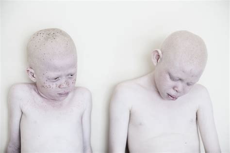 Stunning Photos Show The Beauty Of Albino Children To Raise Awareness