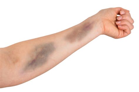 How To Treat A Long Lasting Bruise