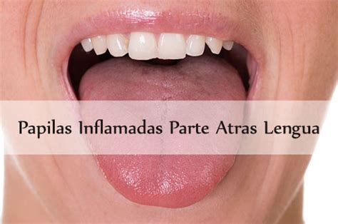 Protuberancias En La Posterior De La Lengua Causas Y Tratamientos