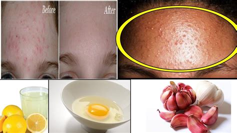 6 Best Ways To Get Rid Of Bumps On Forehead Youtube