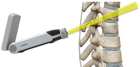 Neuraxial Ultrasound Is Proven To Increase Spinal And Epidural Success