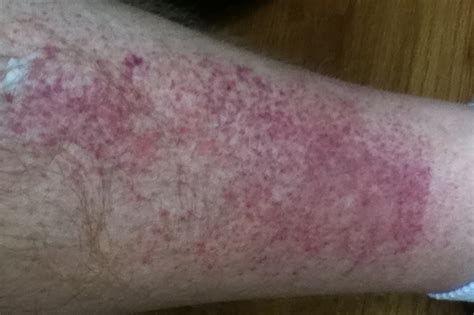 Red Rash On Upper Legs