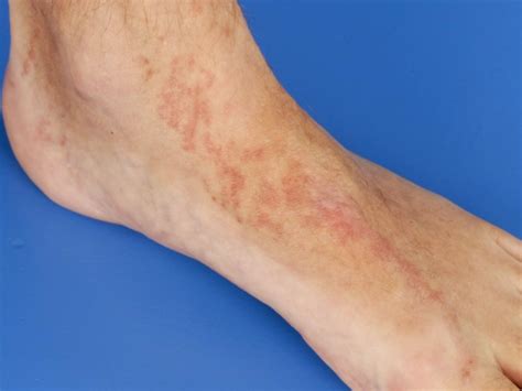 Lichen Striatus Pictures Causes Treatment Symptoms