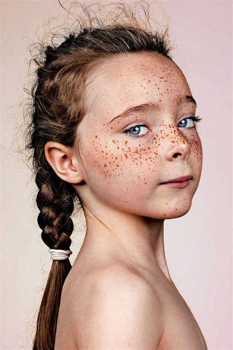 Understanding Freckles Causes Treatments And Tips For Adults Justinboey