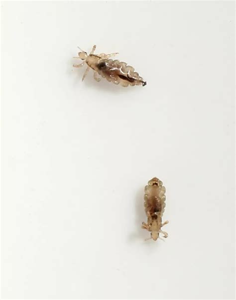 Worst Case Of Head Lice Ever Will Make You Itchy Video