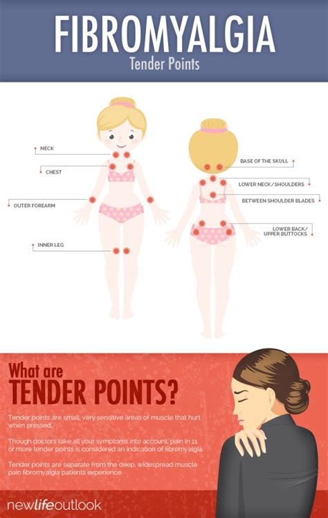 What And Where Are The Tender Points Of Fibromyalgia Fibromyalgia 247