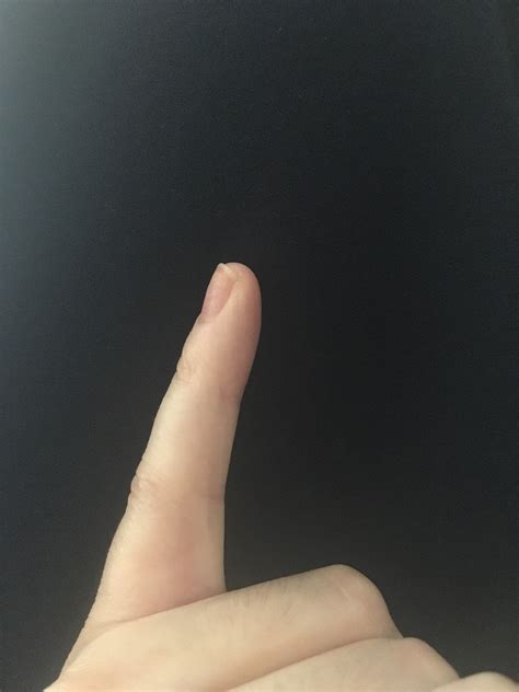 To go to A&E for a broken finger? | Mumsnet