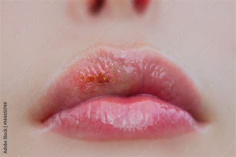 Herpes Virus On Sick Female Lips Therapeutic Lip Balm Infectious