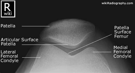 Knee Trauma Radiographic Anatomy Wikiradiography