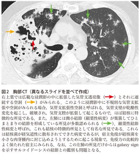 有关历史、生物、科技、人文、地理、生活等所有话题。 not a satire/meme sub, english speakers please refer to rule 7. 【解答・解説】咳と労作時呼吸困難の増悪で来院した40歳代男性 ...