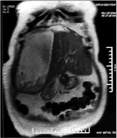Magnetic Resonance Cholangiopancreatography Showing Type Ii Gallbladder