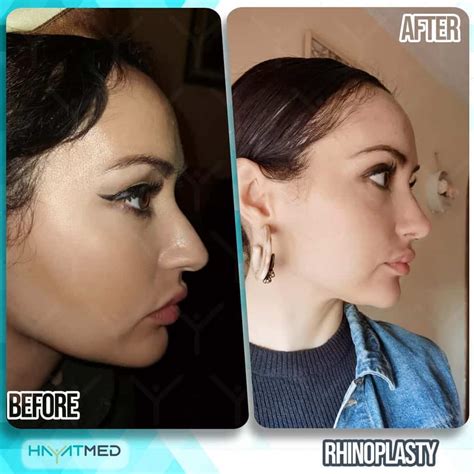 Rhinoplasty Before And After Pictures Risks And Price