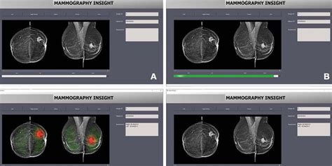 Ai Technology Used To Read Mammograms Could Put Patients At Potential