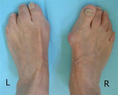 Toe Deformities The Foot And Ankle Online Journal