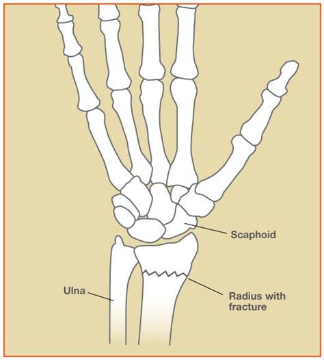 Wrist Fractures Jackson Orthopaedics Jackson Orthopaedics