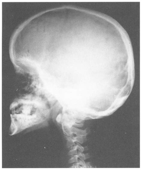 Lateral Skull Radiograph Disclosing Frontal Bossing Hypoplastic