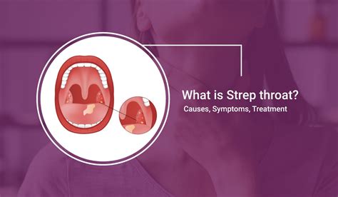 Strep Throat Causes Symptoms Treatment Ace Neuro ENT Clinic