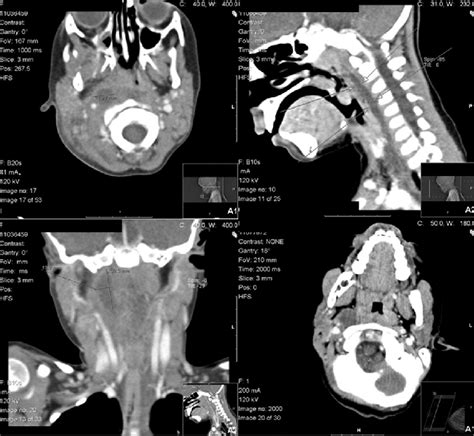 A Latero And Retropharyngeal Abscess Ct Scan Axial View B Latero