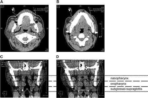 Radiographic Landmarks Of The Parapharynx The Maxillary Tuberosities