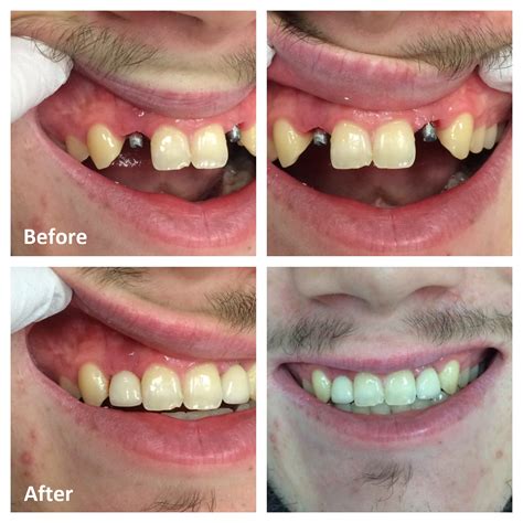 Single Tooth Dental Implant Ottawa Front Tooth Replacement