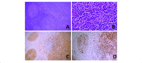 Transformation Of Follicular Lymphoma Fl In A Diffuse Large B Cell