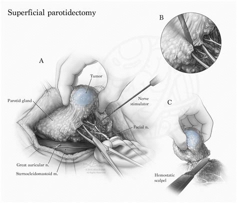 Superficial Parotidectomy Alisa Brandts Portfolio