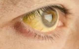 Синдром Жильбера: что это такое – простыми словами, симптомы, лечение Картинка - Синдром Жильбера: что это такое – простыми словами, симптомы, лечение