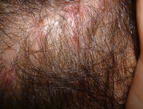 Folliculitis Hair Loss - Causes, Precautions, And Treatment