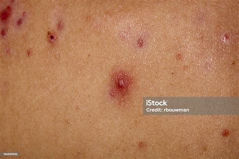 Isolated Closeup Images Of Painful Cystic Acne Stock Photo Download
