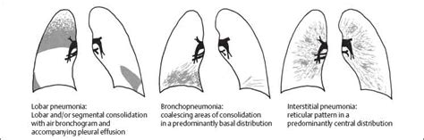 Lobar pneumonia affects one or more sections (lobes) of the lungs. Infection and Inflammatory Disorders | Radiology Key