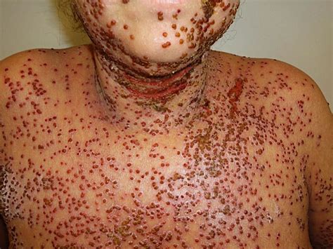 Widespread Eruption In A Patient With Atopic Dermatitis Emergency