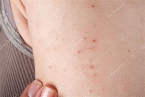 Dermatite Allergica Eruzione Cutanea Foto Stock Foto Immagini
