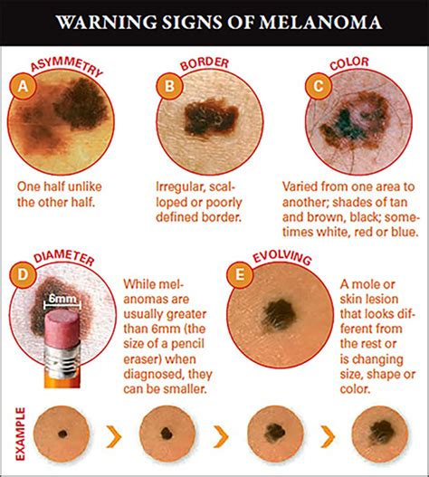 Abcdes Of Melanoma Pariser Dermatology