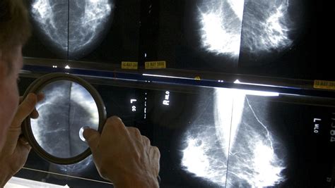 Deadly Breast Cancers Are Rising In Young Women