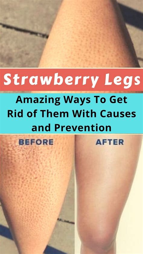 Strawberry Legs Amazing Ways To Get Rid Of Them With Causes And